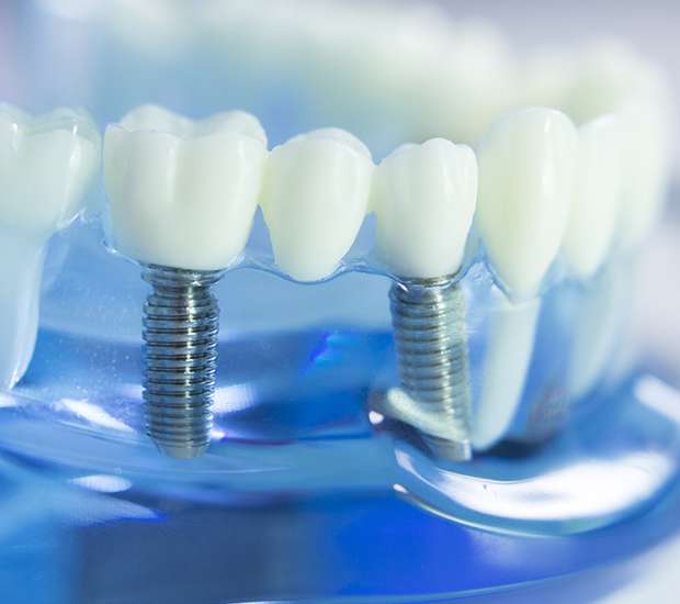 Pottstown Dental Implants