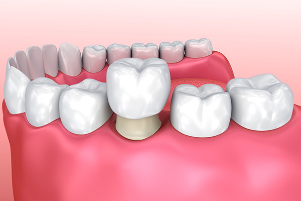 Teeth Repair